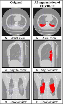 AI-Assisted CT as a Clinical and Research Tool for COVID-19